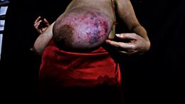 Tits bruised