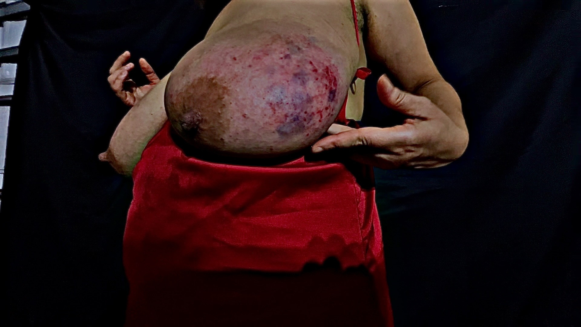 Tits bruised