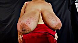 Tits bruised