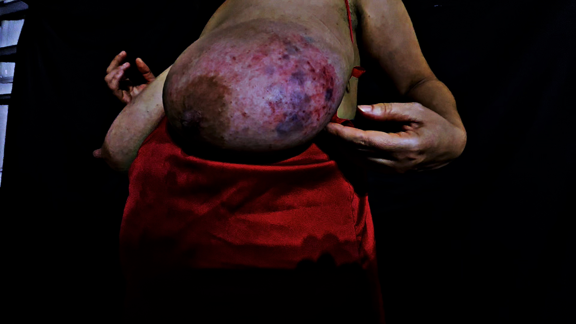 Tits bruised